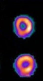 A Narrative-Review on Transient Ischemic Dilatation from Single Photon Emission Computed Tomography Myocardial Perfusion Imaging